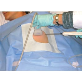 Ultrasound Sterile Biopsy Drape - Marketlab